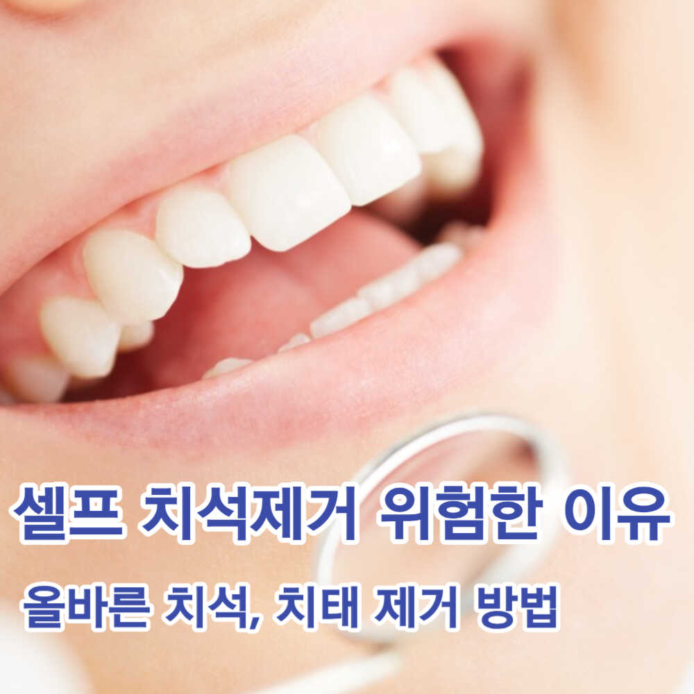 셀프 치석 제거